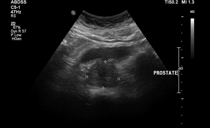 Ultrasoinu prostatitisa ZXCVBNMQWER hartu aurretik