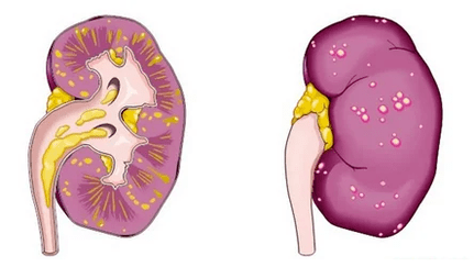 Prostatitis akutua zer da