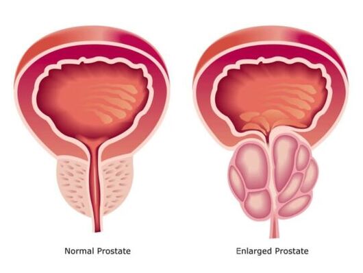 Prostata normala eta handitua