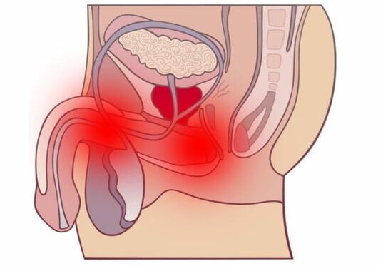 Prostatitis akutua