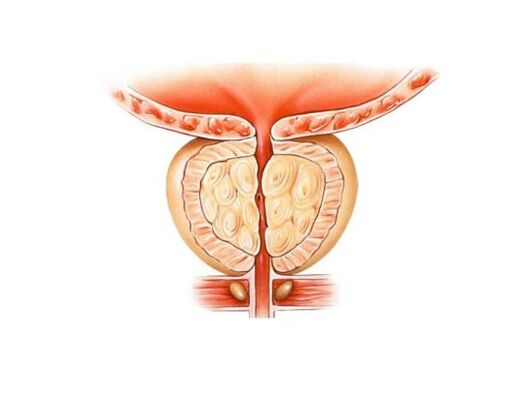 Prostatitisarekin prostata handitu da